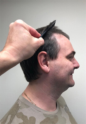 hair transplant before after Photos