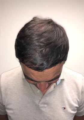 hair transplant before after Photos