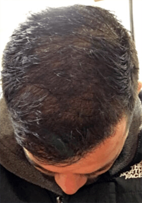 hair transplant before after Photos