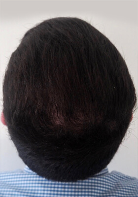 hair transplant before after Photos