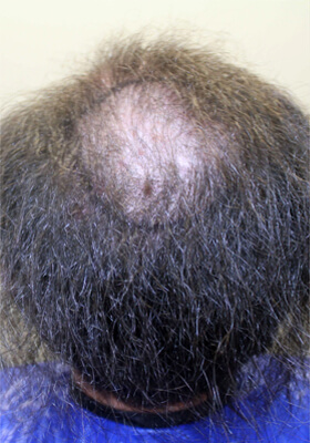 hair transplant before after Photos