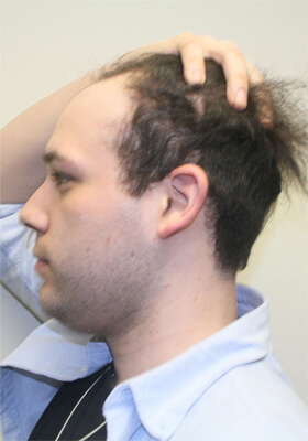 hair transplant before after Photos