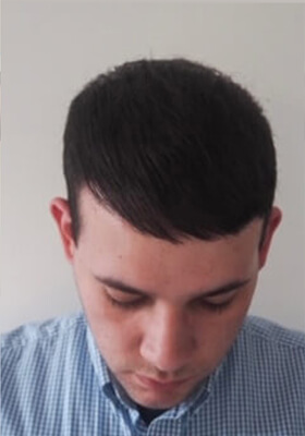 hair transplant before after Photos