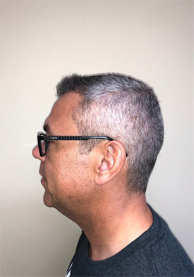 hair transplant before after Photos