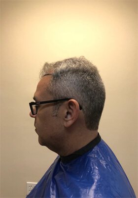 hair transplant before after Photos