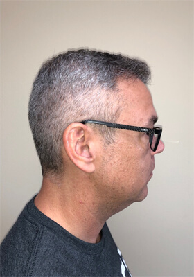 hair transplant before after Photos