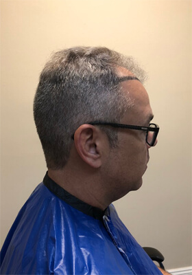 hair transplant before after Photos