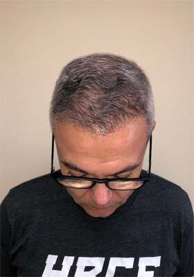 hair transplant before after Photos