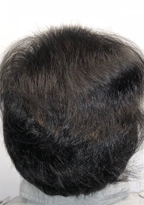 hair transplant photos