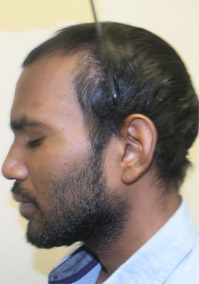 hair transplant before after Photos