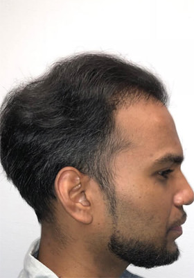 hair transplant before after Photos