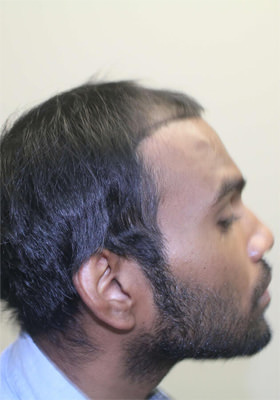 hair transplant photos