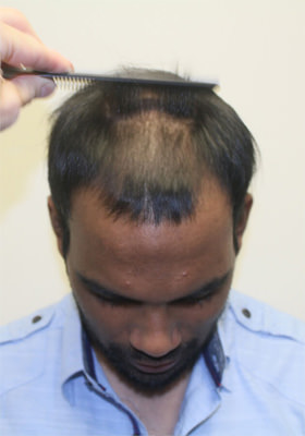 hair transplant before after Photos