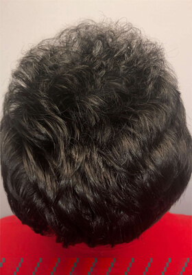 hair transplant before after Photos