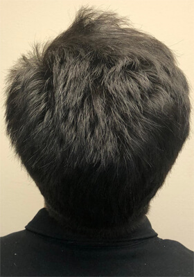 hair transplant before after Photos