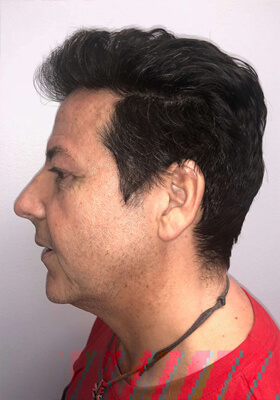 hair transplant before after Photos