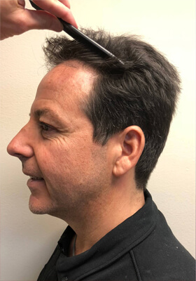 hair transplant before after Photos