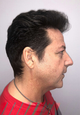 hair transplant before after Photos