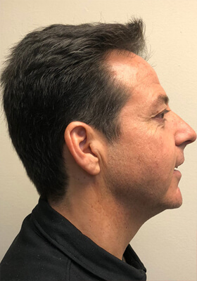 hair transplant before after Photos