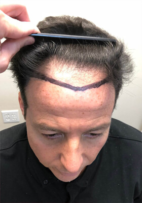 hair transplant before after Photos