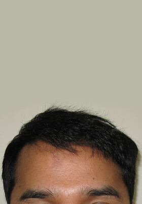 hair transplant photos