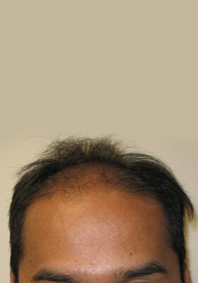 hair transplant photos