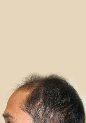 hair transplant photos