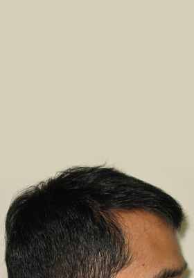 hair transplant photos