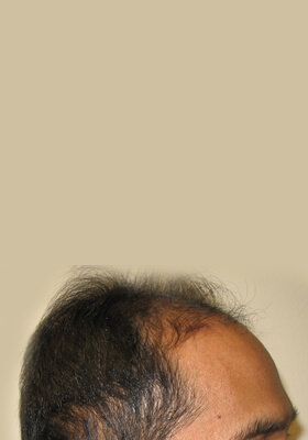 hair transplant photos