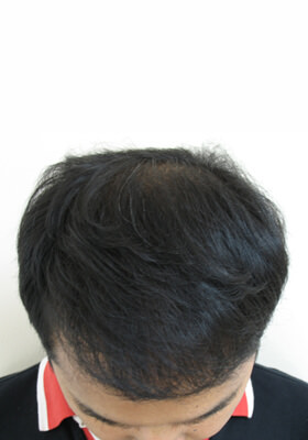 hair transplant before after Photos