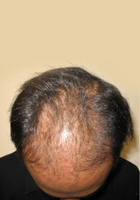 hair transplant photos