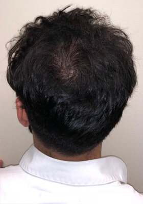 hair transplant before after Photos