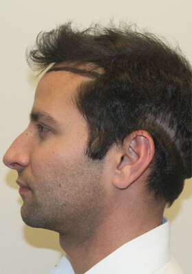 hair transplant before after Photos