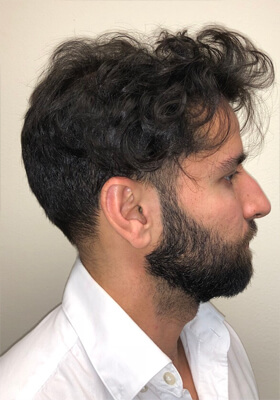 hair transplant before after Photos