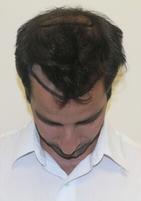 hair transplant before after Photos