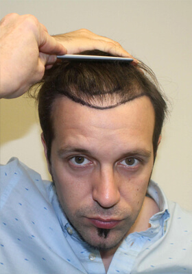 hair transplant before after Photos