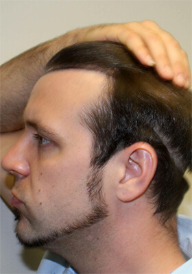 hair transplant before after Photos