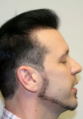 hair transplant before after Photos