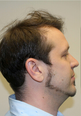 hair transplant before after Photos