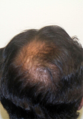 hair transplant before after Photos