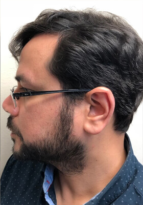 hair transplant before after Photos