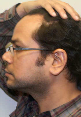 hair transplant before after Photos