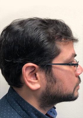 hair transplant before after Photos