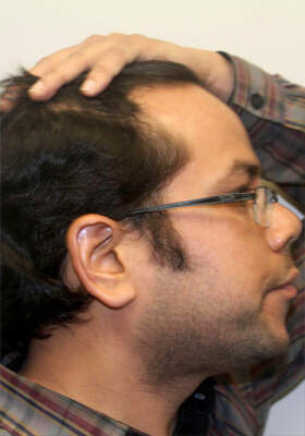 hair transplant before after Photos