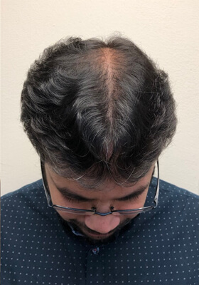 hair transplant before after Photos