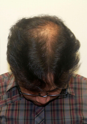 hair transplant before after Photos