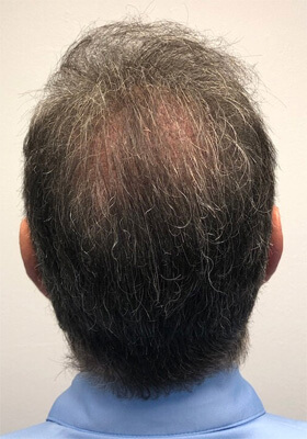 hair transplant before after Photos