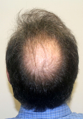 hair transplant before after Photos