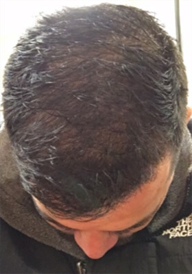 hair transplant before after Photos