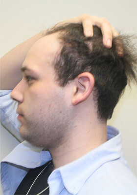 hair transplant before after Photos